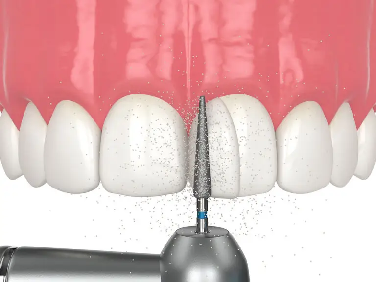 Dental Bonding In Marshall, TX: A Simple Way To Repair Chips, Gaps, And Uneven Edges