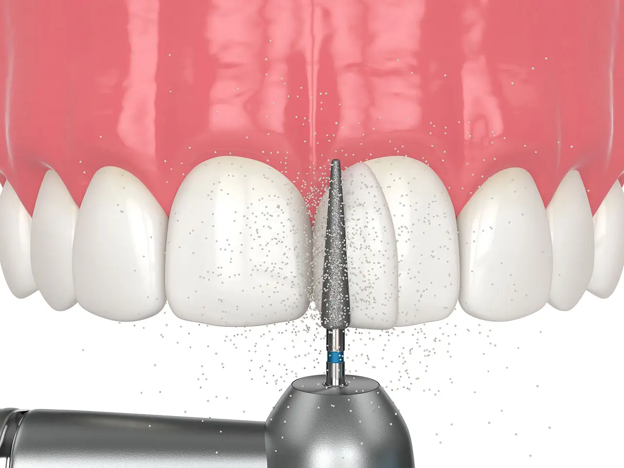 Dental Bonding In Marshall, TX: A Simple Way To Repair Chips, Gaps, And Uneven Edges