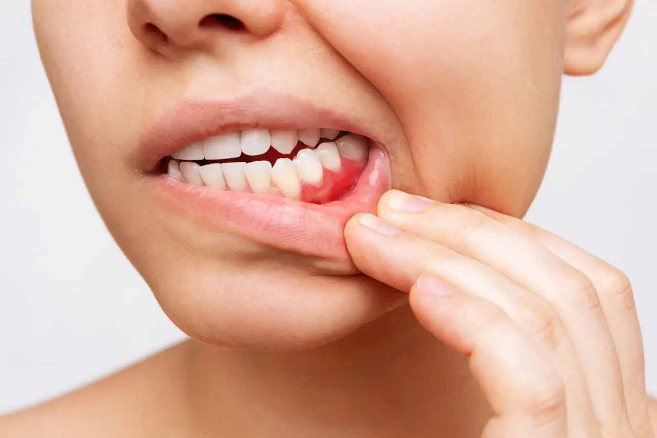 Gum Disease Treatment In Marshall, TX: Protecting The Foundation Of Your Smile