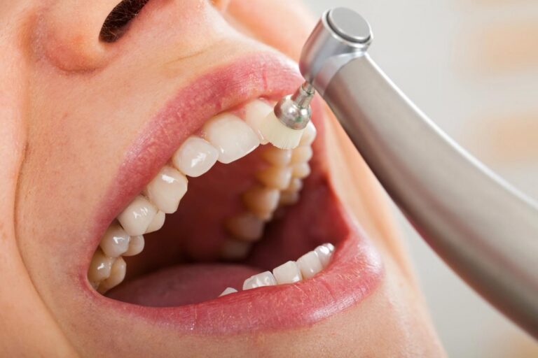 Close-up of a patient's tooth being polished by a dental tool.
