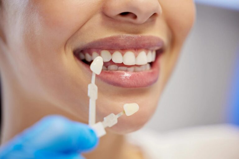 Smiling patient's teeth being matched with a dental veneer.