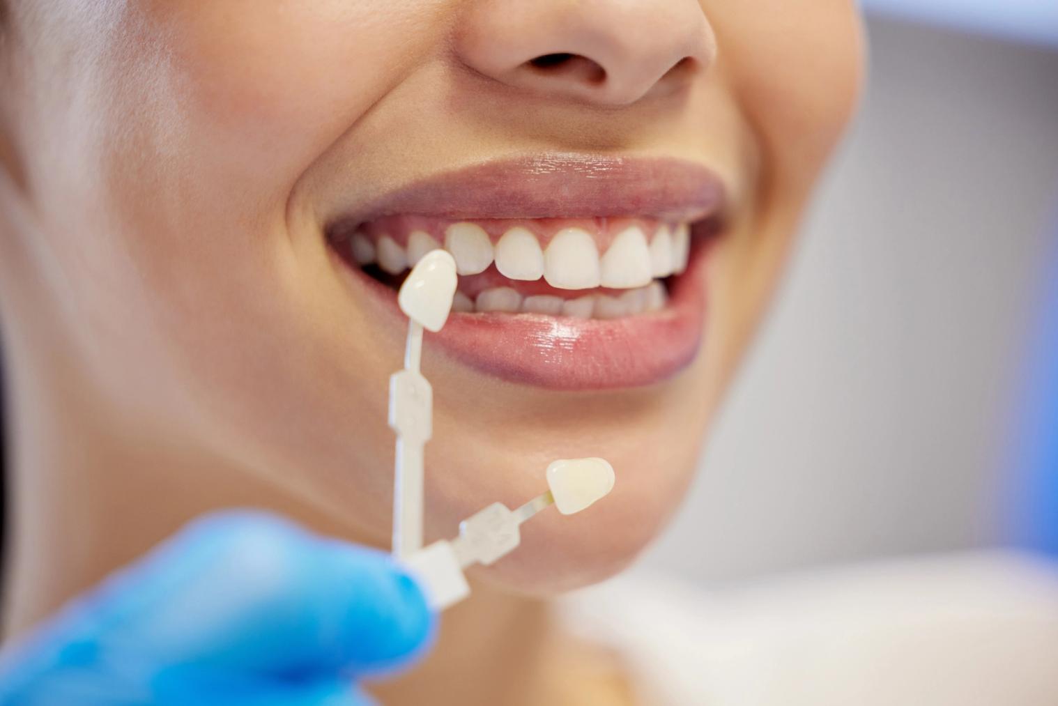 Smiling patient's teeth being matched with a dental veneer.