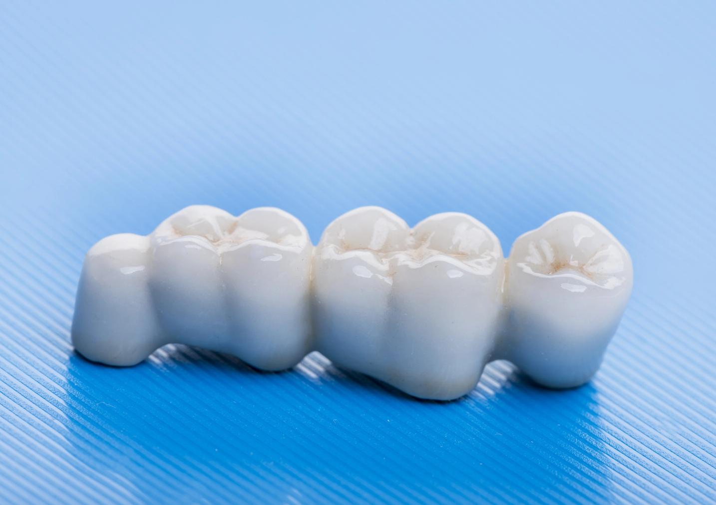 White dental bridge with four crowns on a blue background.